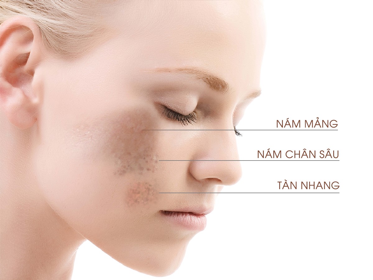 Nhận biết sự khác nhau giữa nám da và tàn nhang