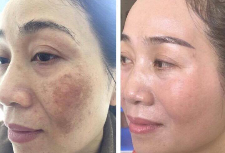 Hiệu quả trị nám công nghệ Mesotherapy