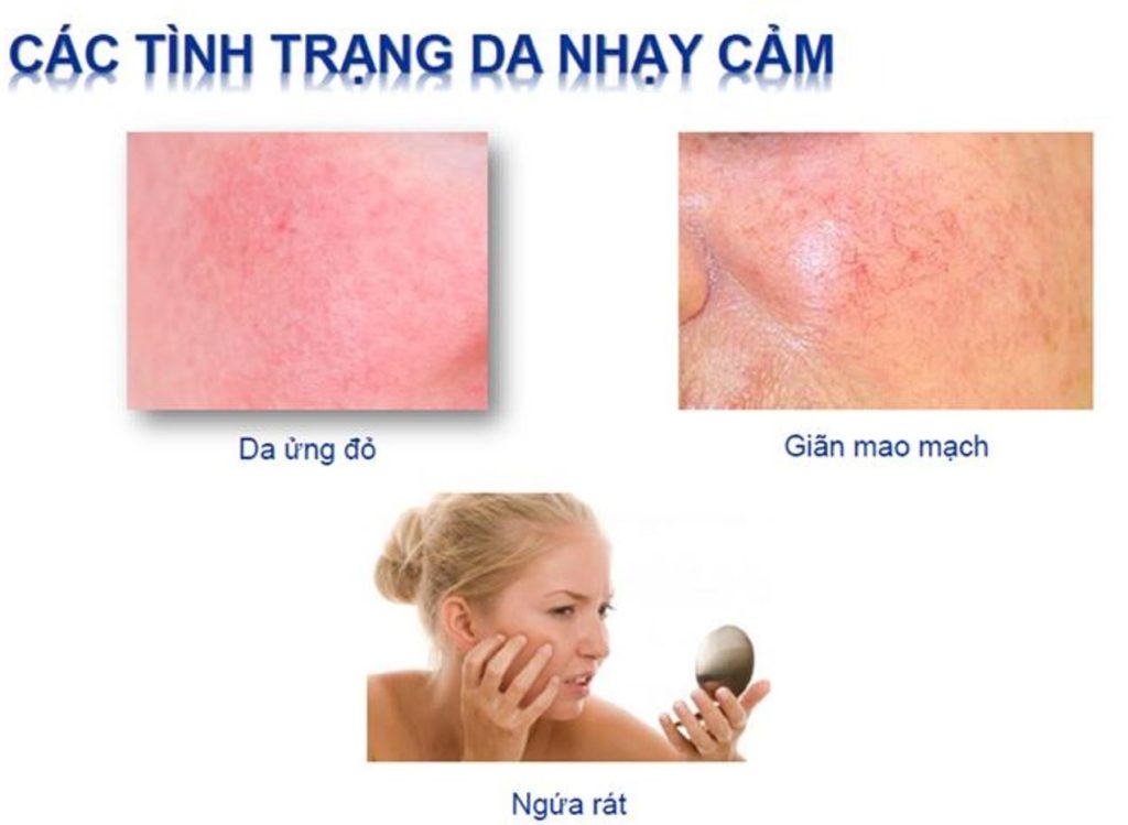 Tình trạng chung của da nhạy cảm