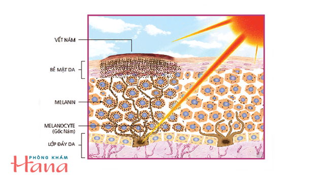 Melanin bị kích hoạt do tác động của tia UV